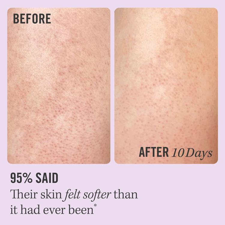 First Aid Beauty  KP Bump Eraser Body Scrub with 10% AHA – Body Exfoliant for Keratosis Pilaris 4